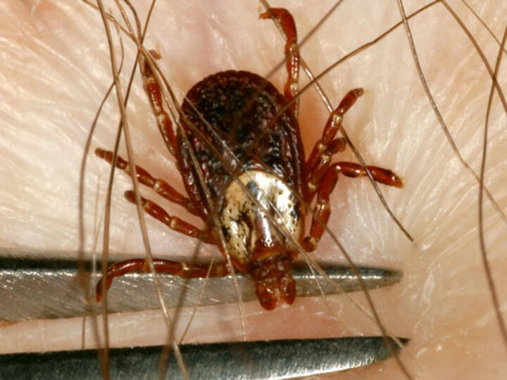 american dog tick removal with tweezers